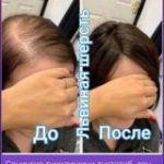 Tukilgan sochlarni qayta tiklash